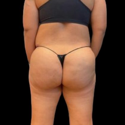 Aveli (Cellulite Removal) Before & After Patient #6433