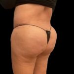 Aveli (Cellulite Removal) Before & After Patient #6433