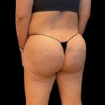 Aveli (Cellulite Removal) Before & After Patient #6433