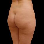 Brazilian Butt Lift Before & After Patient #6167
