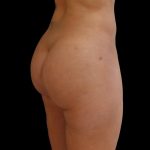 Brazilian Butt Lift Before & After Patient #6167
