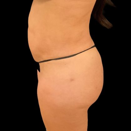 Brazilian Butt Lift Before & After Patient #8921