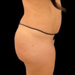 Brazilian Butt Lift Before & After Patient #8921