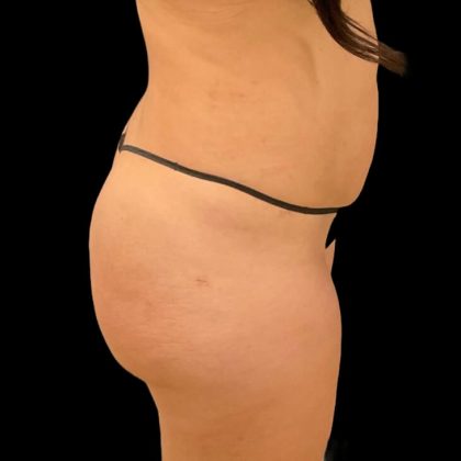 Brazilian Butt Lift Before & After Patient #8921