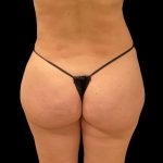 Brazilian Butt Lift Before & After Patient #8921