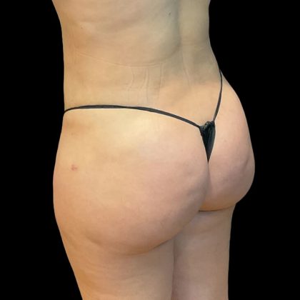 Brazilian Butt Lift Before & After Patient #8921