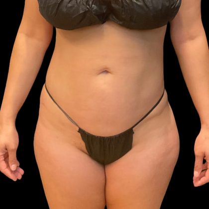 Brazilian Butt Lift Before & After Patient #8921