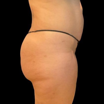 Brazilian Butt Lift Before & After Patient #8921