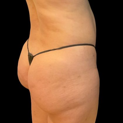 Brazilian Butt Lift Before & After Patient #8921