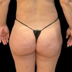 Brazilian Butt Lift Before & After Patient #8921