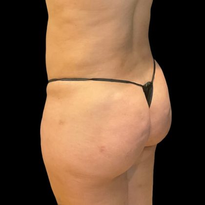 Brazilian Butt Lift Before & After Patient #8921