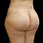 Brazilian Butt Lift Before & After Patient #9071