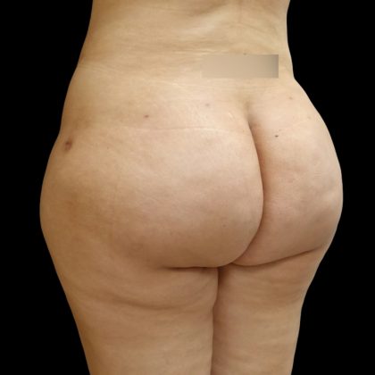 Brazilian Butt Lift Before & After Patient #9071