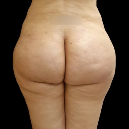 Brazilian Butt Lift Before & After Patient #9071