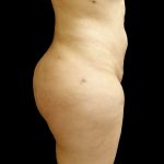 Brazilian Butt Lift Before & After Patient #9071