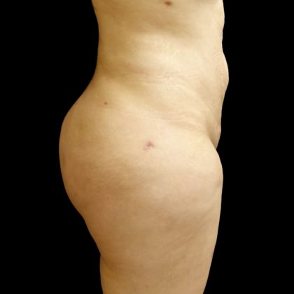 Brazilian Butt Lift Before & After Patient #9071