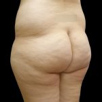 Brazilian Butt Lift Before & After Patient #9071