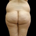 Brazilian Butt Lift Before & After Patient #9071