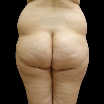 Brazilian Butt Lift Before & After Patient #9071