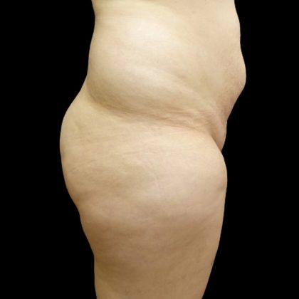 Brazilian Butt Lift Before & After Patient #9071