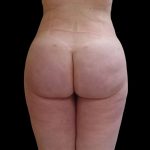 Brazilian Butt Lift Before & After Patient #9079