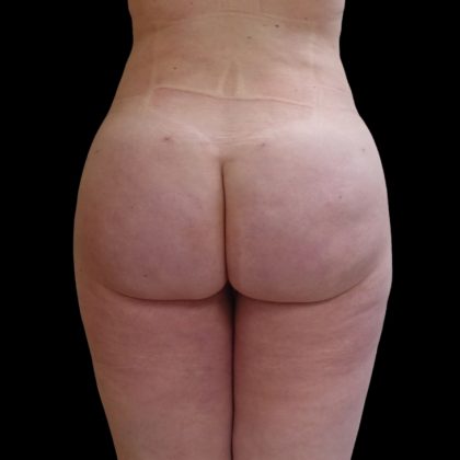 Brazilian Butt Lift Before & After Patient #9079