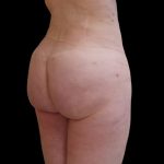 Brazilian Butt Lift Before & After Patient #9079