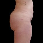 Brazilian Butt Lift Before & After Patient #9079