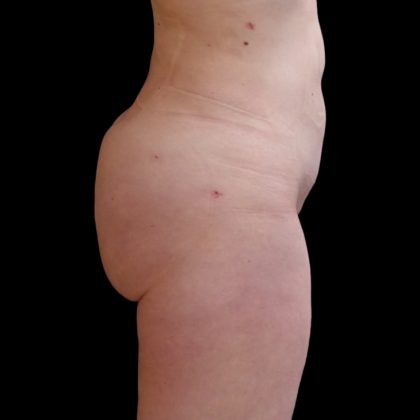 Brazilian Butt Lift Before & After Patient #9079