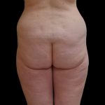 Brazilian Butt Lift Before & After Patient #9079