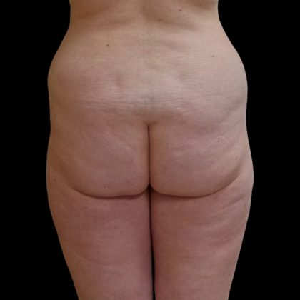 Brazilian Butt Lift Before & After Patient #9079
