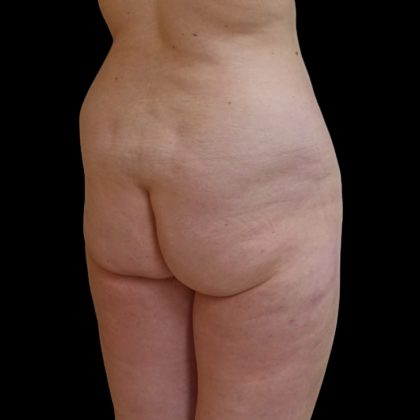 Brazilian Butt Lift Before & After Patient #9079