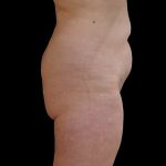 Brazilian Butt Lift Before & After Patient #9079