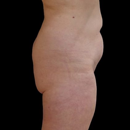 Brazilian Butt Lift Before & After Patient #9079