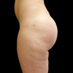 Brazilian Butt Lift Before & After Patient #9086