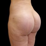 Brazilian Butt Lift Before & After Patient #9086
