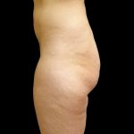 Brazilian Butt Lift Before & After Patient #9086