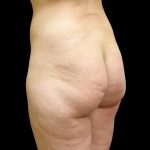 Brazilian Butt Lift Before & After Patient #9086