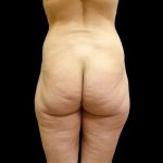 Brazilian Butt Lift Before & After Patient #9086