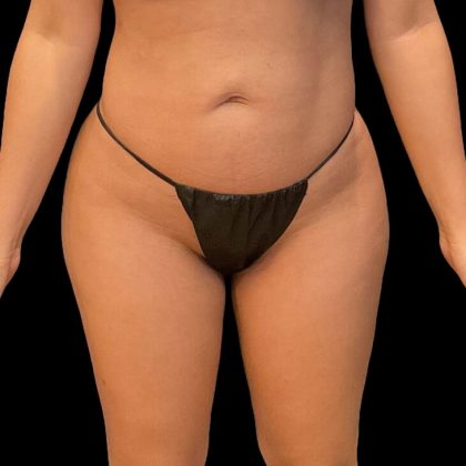 Brazilian Butt Lift Before & After Patient #9093