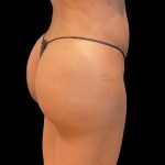 Brazilian Butt Lift Before & After Patient #9093