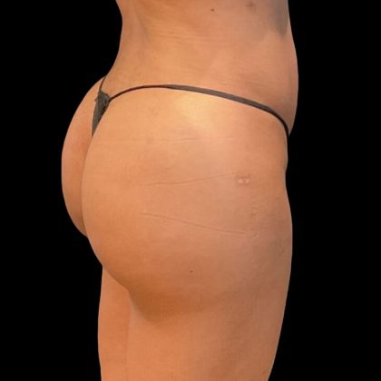 Brazilian Butt Lift Before & After Patient #9093