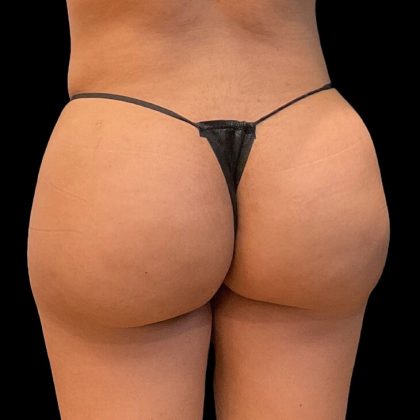 Brazilian Butt Lift Before & After Patient #9093