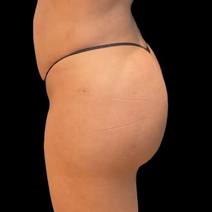 Brazilian Butt Lift Before & After Patient #9093