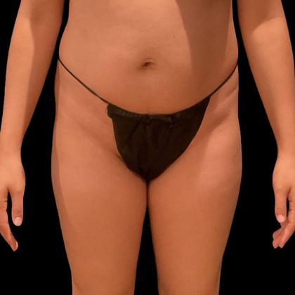 Brazilian Butt Lift Before & After Patient #9093
