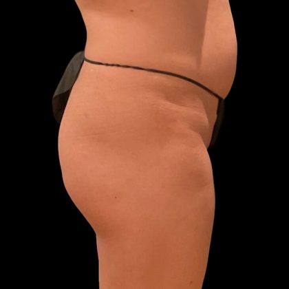Brazilian Butt Lift Before & After Patient #9093