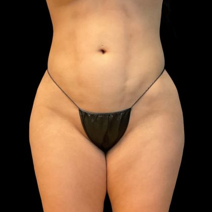 Brazilian Butt Lift Before & After Patient #9108