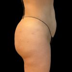 Brazilian Butt Lift Before & After Patient #9108