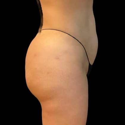 Brazilian Butt Lift Before & After Patient #9108