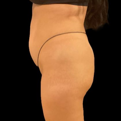 Brazilian Butt Lift Before & After Patient #9108